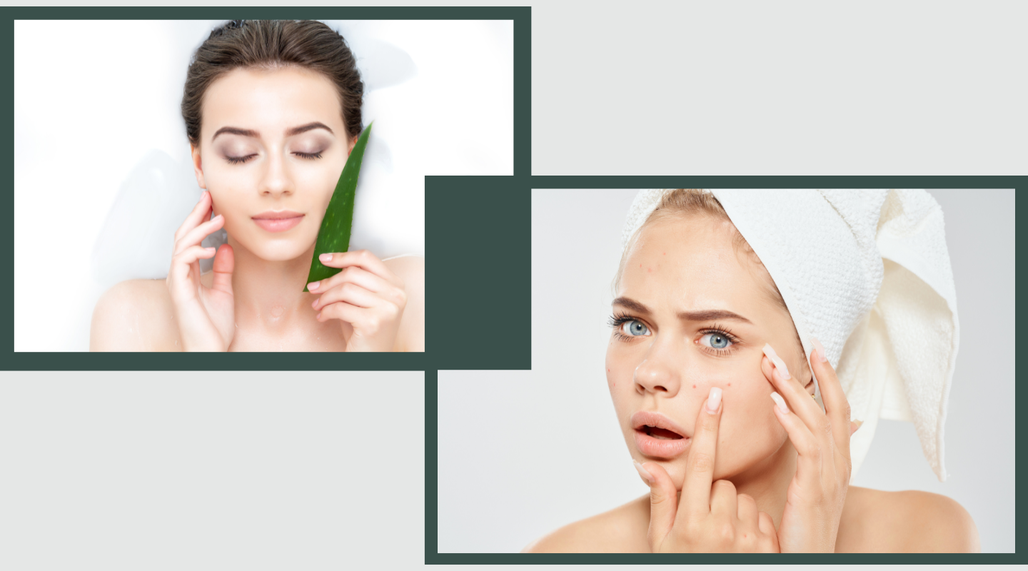 Say Goodbye to Acne with Aloe Vera: Nature's Miracle Healer!